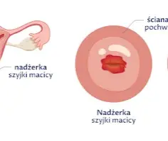 Obniżenie szyjki macicy objawy – jak rozpoznać niepokojące symptomy
