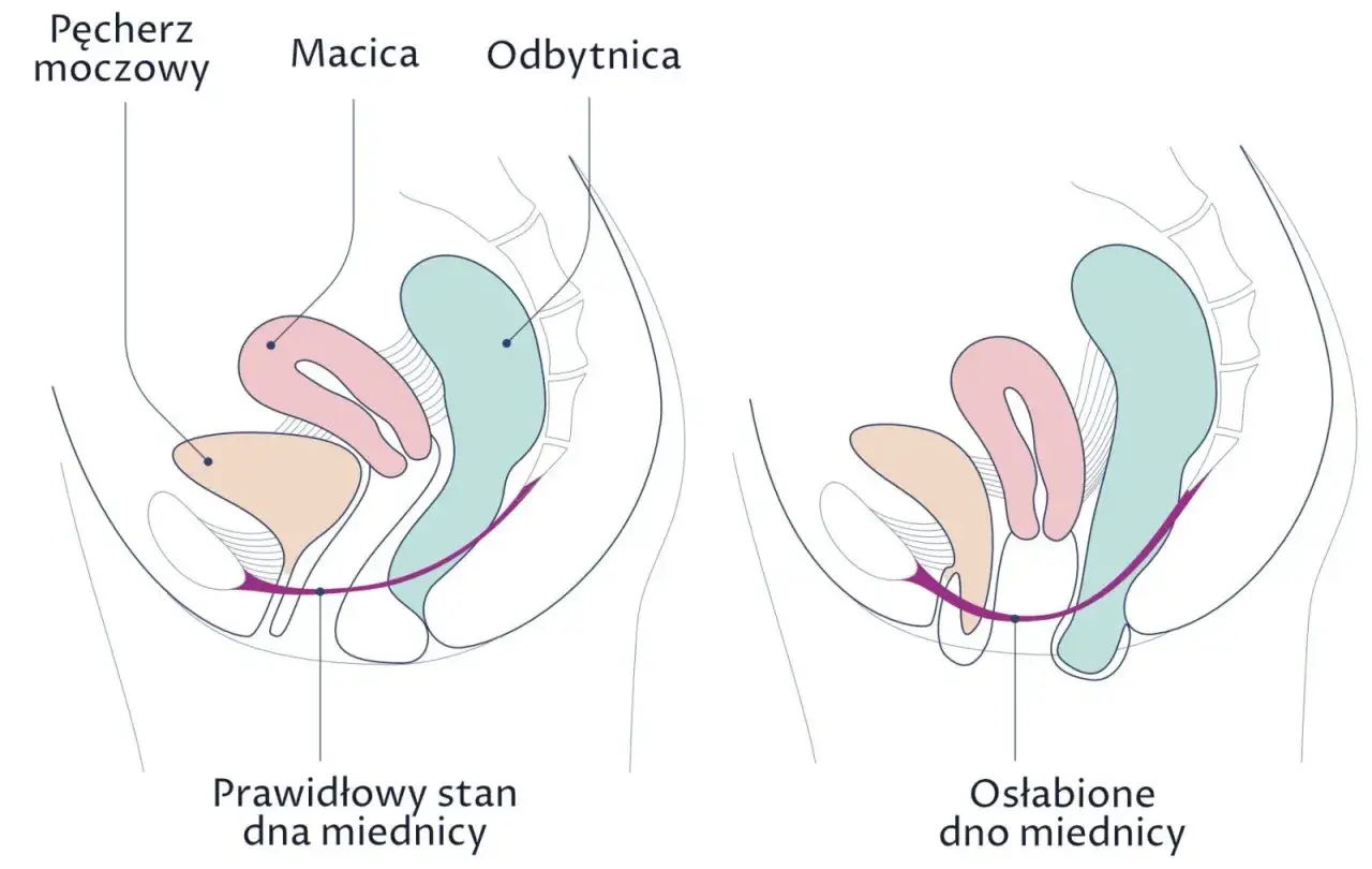 Zdjęcie Obniżenie szyjki macicy objawy – jak rozpoznać niepokojące symptomy